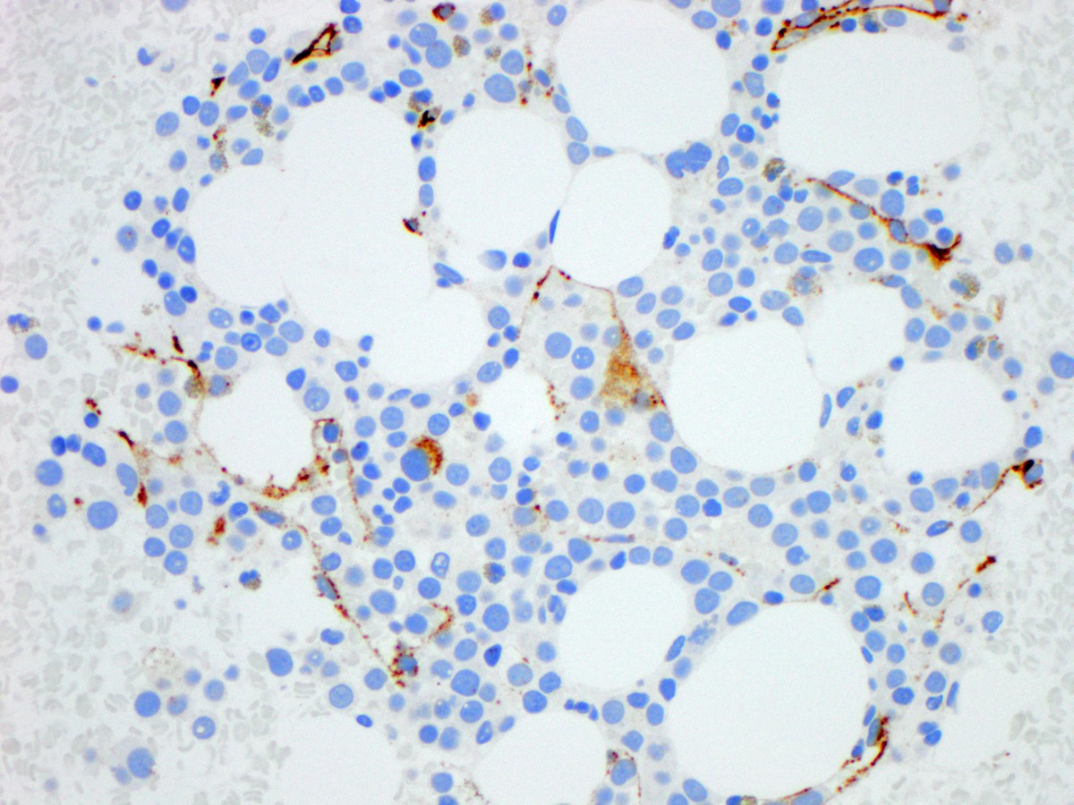 Immature cells are negative for CD34 (400x)